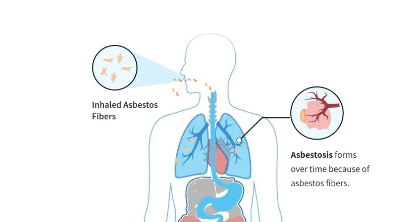 Understanding Asbestos Exposure’s Long-term Health Effects